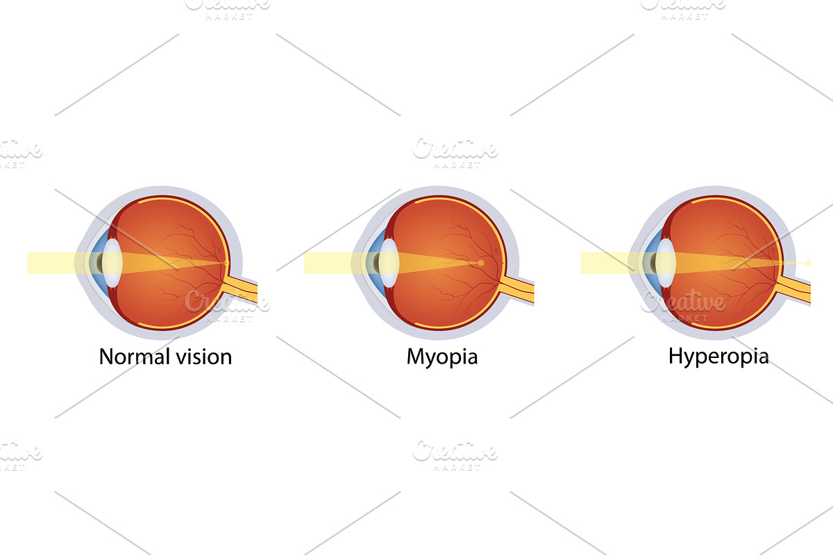 Normal vision, hyperopia, myopia, an Object Illustration by Vector Creator