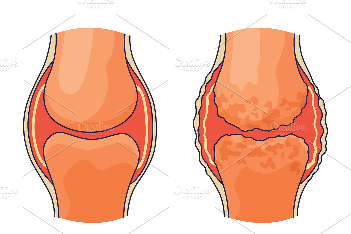 Rheumatoid arthritis. A, an Object Illustration by Things for designers (Photo 3 of 3)