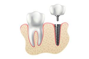 Dental implant structure. Medical, a Healthcare Illustration by the8monkey