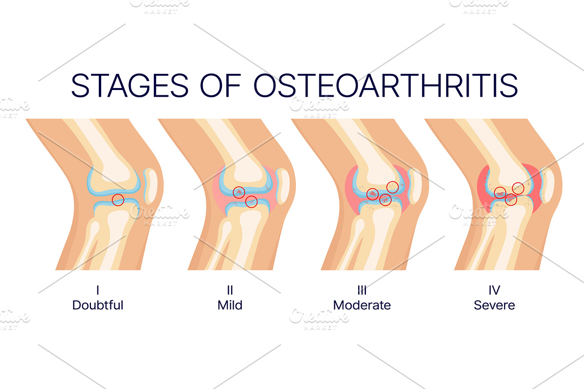Knee osteoarthritis stages, joint, an Object Illustration by Vector Tradition