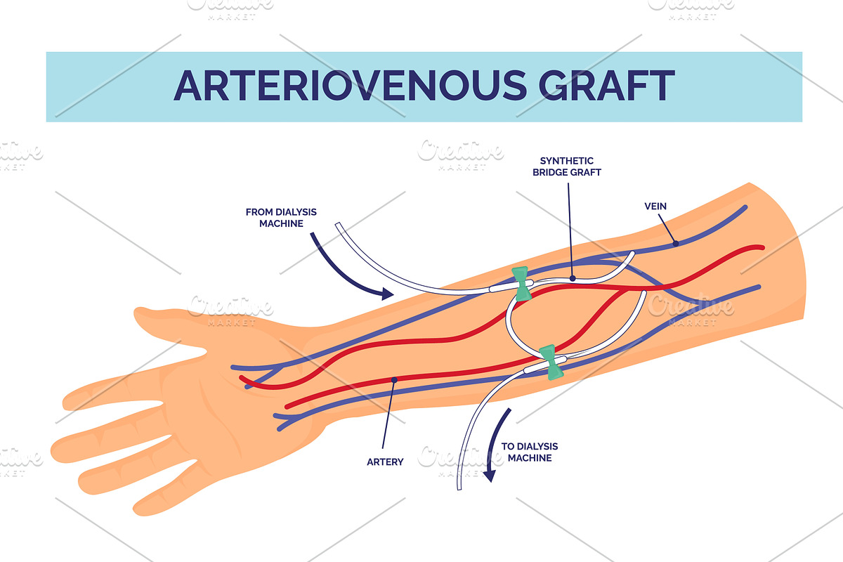 Arteriovenous graft. Venous fistula, a Healthcare Illustration by Stock-Smart-Start