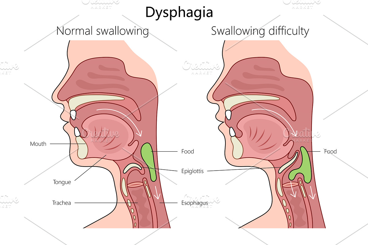 Normal vs Dysphagia Swallowing, an Object Illustration by AlexArt