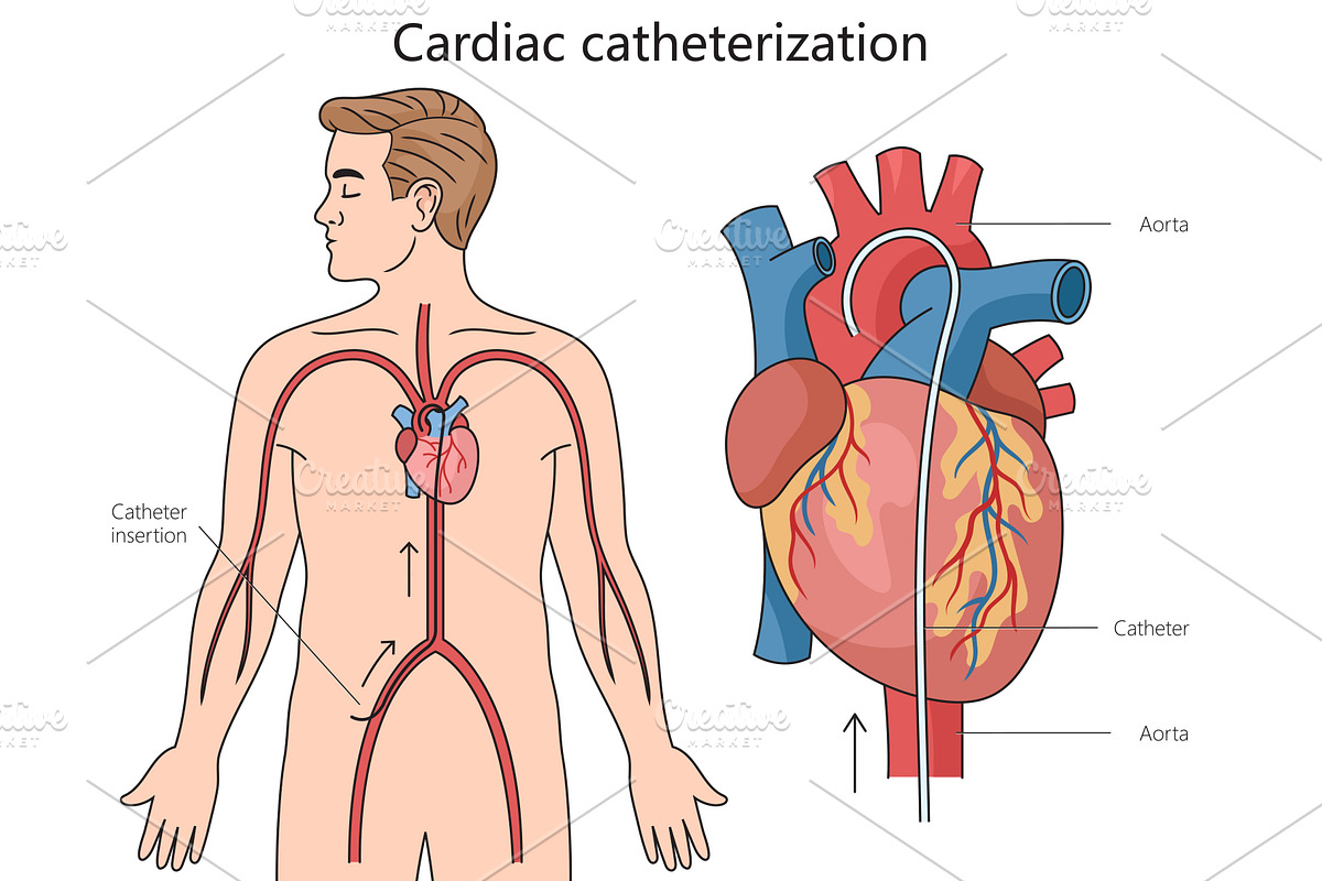 Cardiac catheterization diagram medi, a Healthcare Illustration by AlexArt