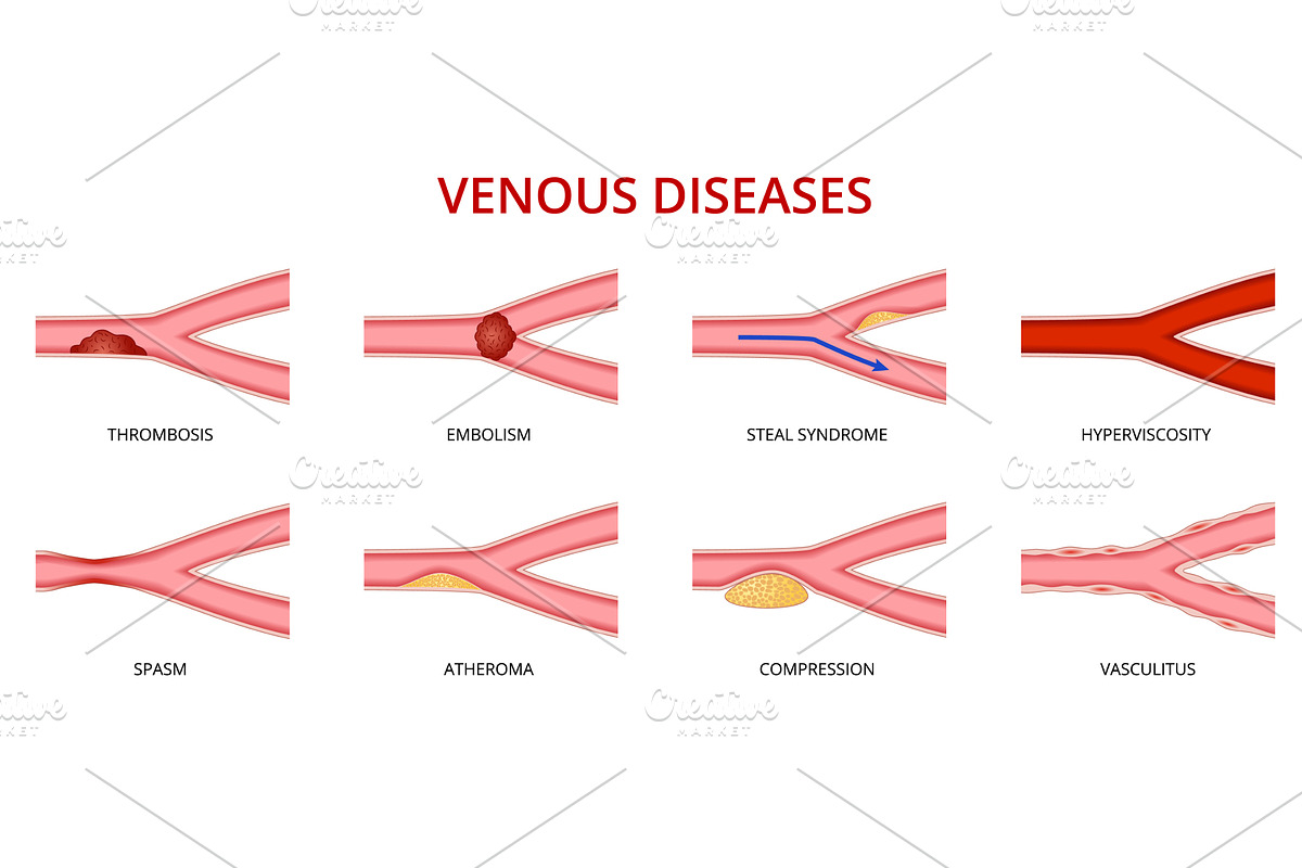 Human vein disease, venous, a Healthcare Illustration by Buch&Bee