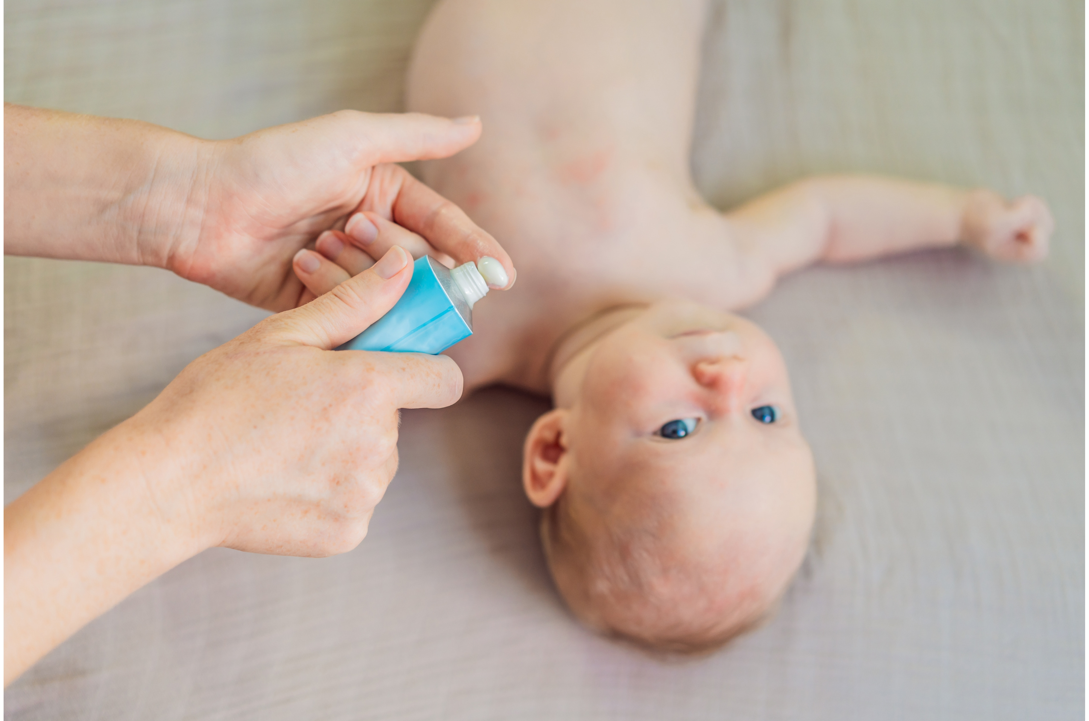 Mother applying anti-rash cream on, a Health & Medical Photo by ...