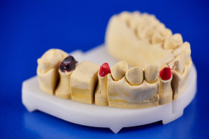 Plaster dental jaw model with prepared teeth abutments marked in red and black, a Health & Medical Photo by Rohan Photography