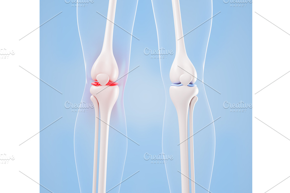 Inflamed and healthy knee joint, a Healthcare Illustration by Marozhkastudio