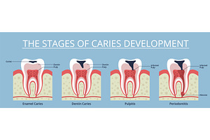 Caries stages. Gradual tooth decay, an Object Illustration by YummyBuum