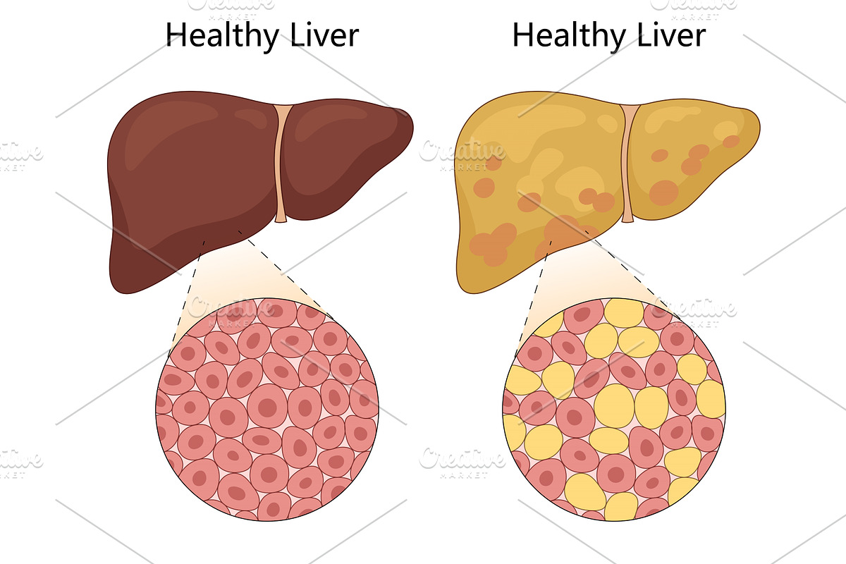 Healthy and Fatty Liver Disease, a Healthcare Illustration by AlexArt