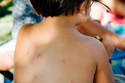 Back of a little girl with infected mosquito bites