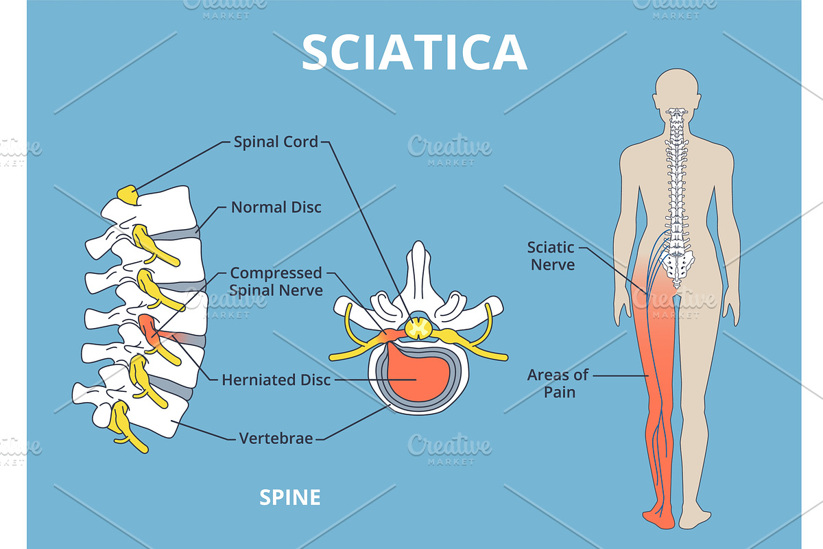 Sciatica pain scheme. Health care, an Object Illustration by YummyBuum