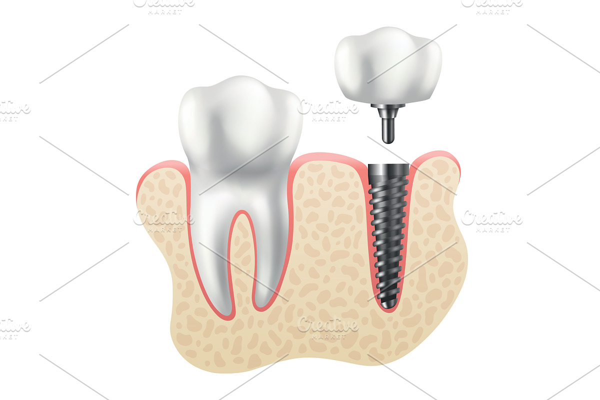 Dental implant structure. Medical, a Healthcare Illustration by the8monkey