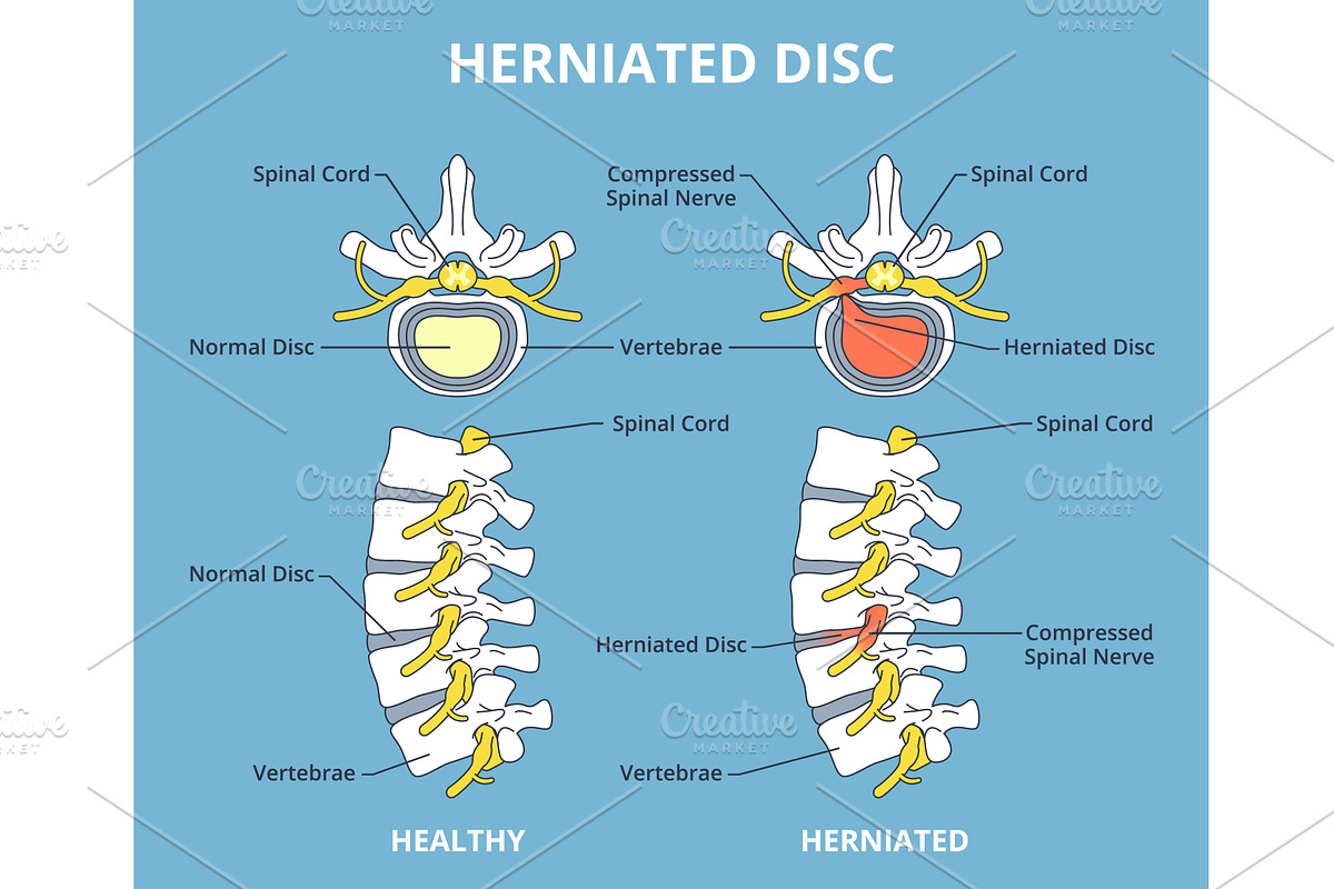 Herniated disc. Sick and healthy, an Object Illustration by YummyBuum
