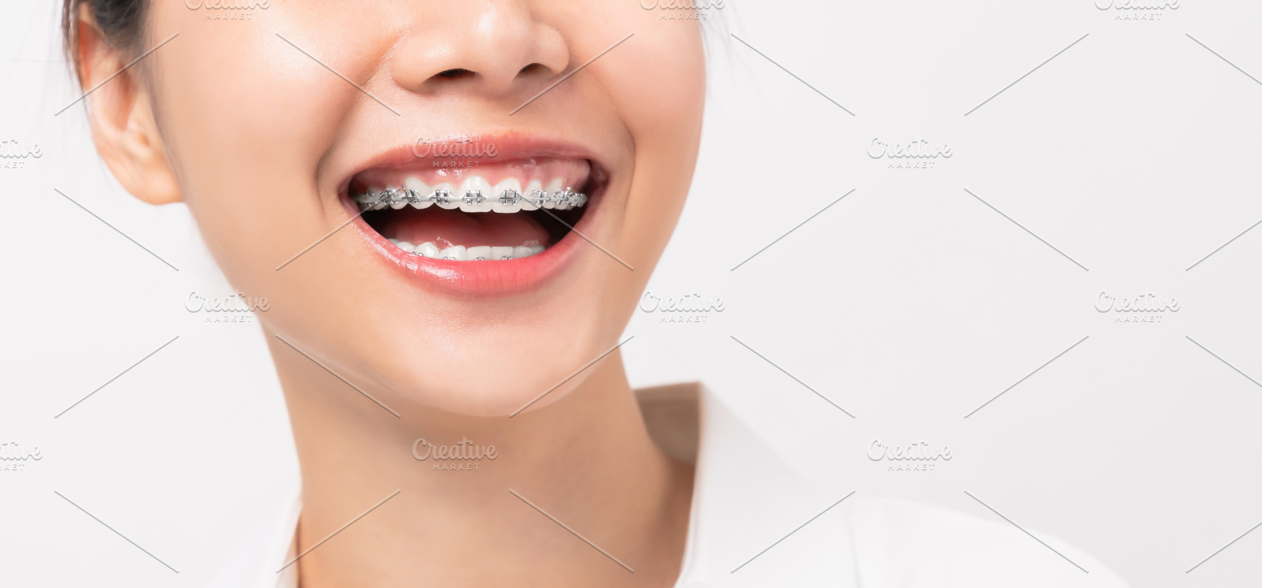 Face of a young smiling asian woman stock photo containing brace and dentist, a Health & Medical Photo by sitthiphong