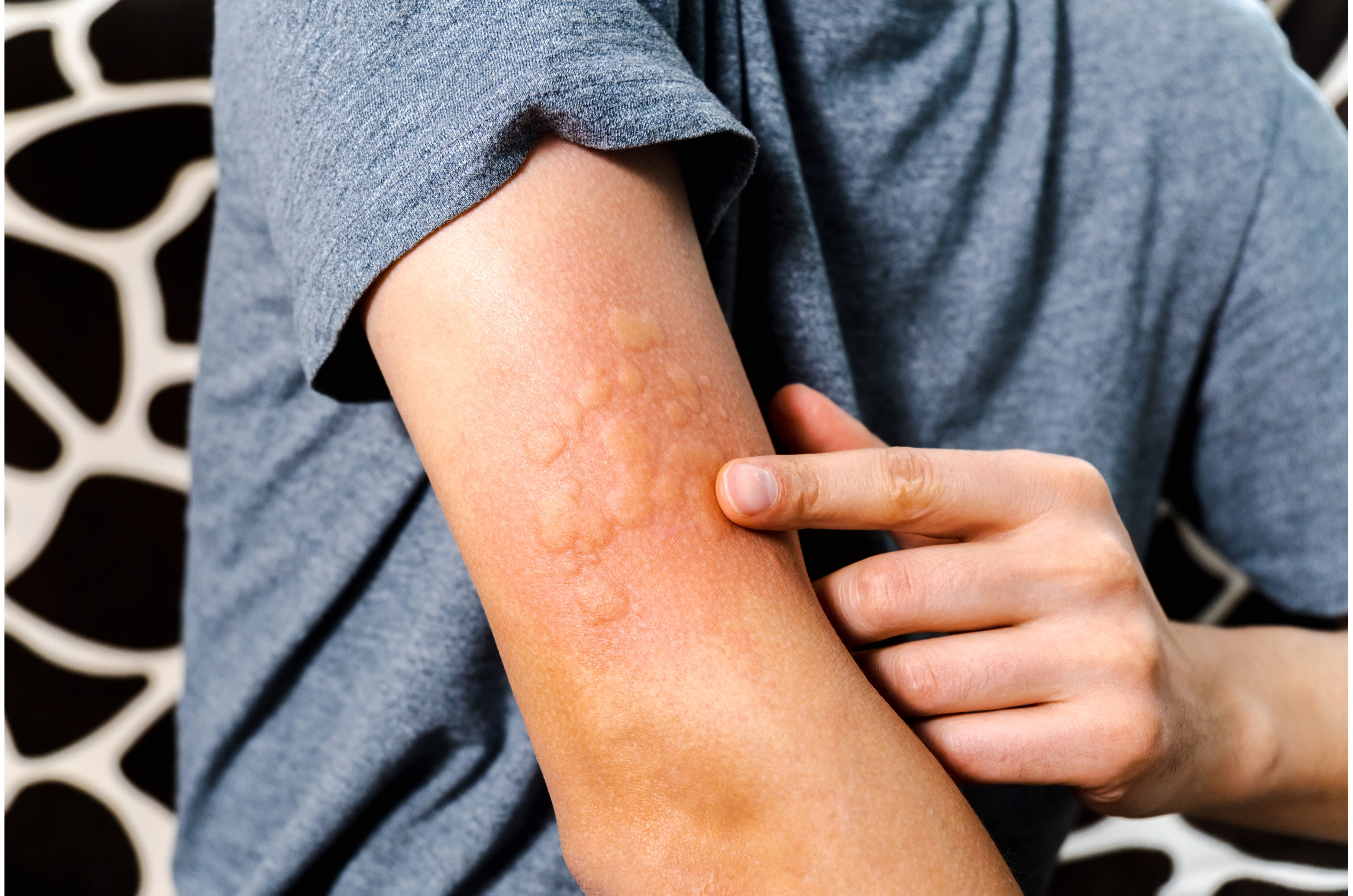 Red rash on skin from allergic, a Health & Medical Photo by darksoul72