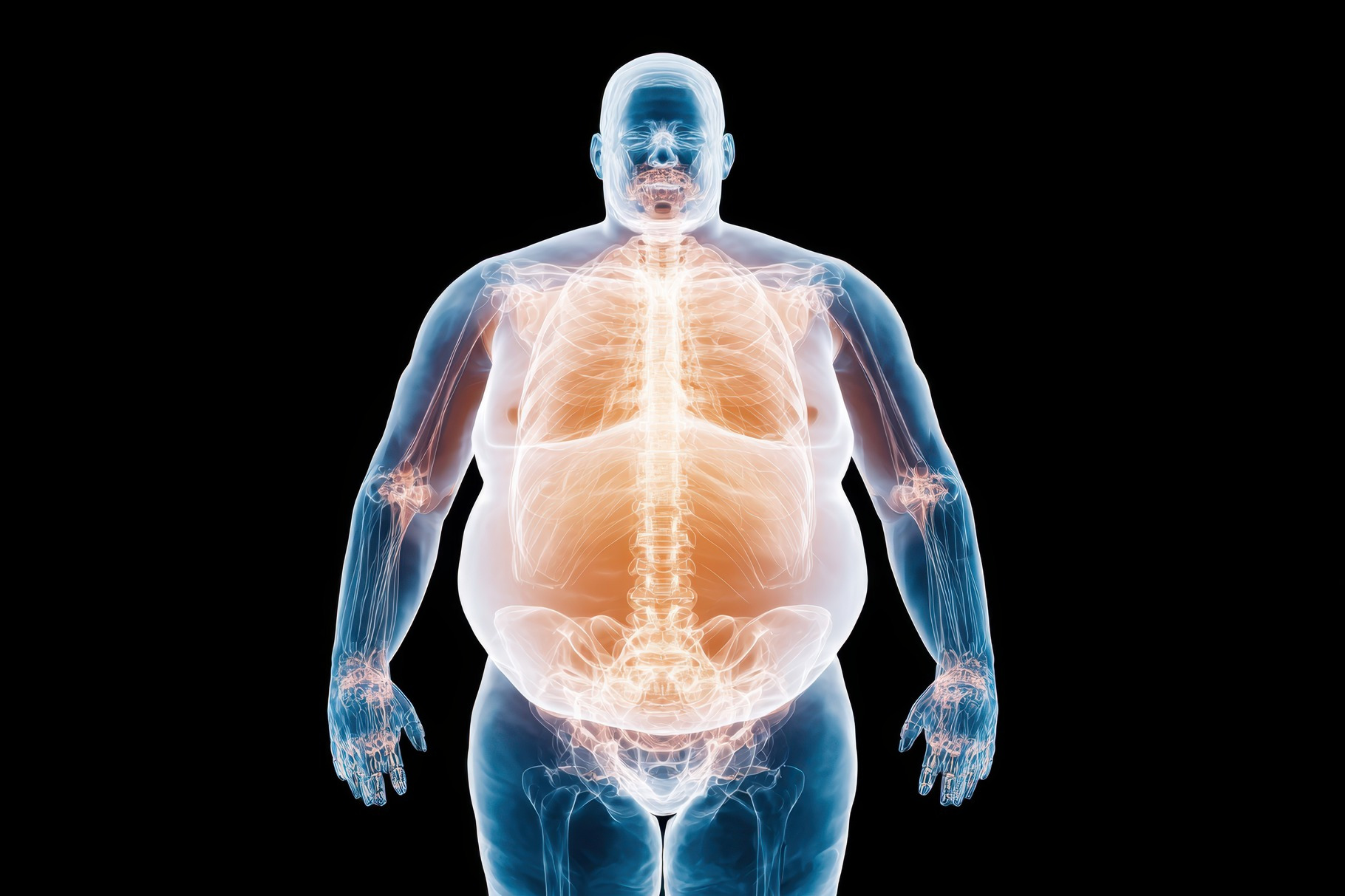 Anatomical illustration of obesity in the human body, a Health ...