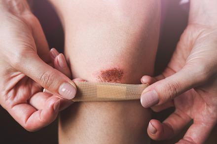 Abrasion on the woman's knee featuring abrasion, accident, and aid