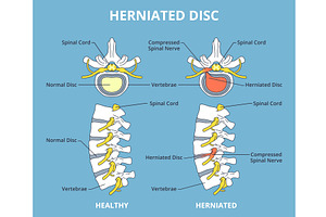 Herniated disc. Sick and healthy, an Object Illustration by YummyBuum