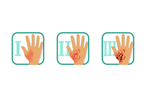 Degree of Skin Burns Set, Normal to, an Object Illustration by TopVectors