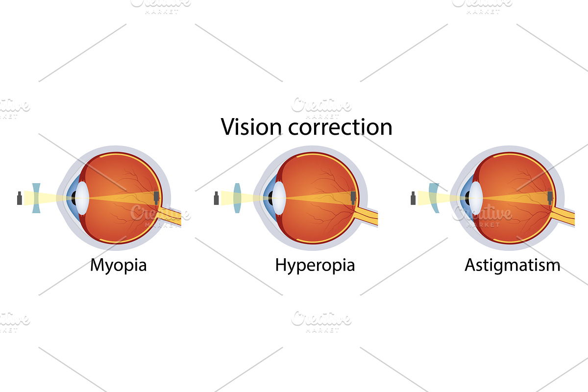 Correction of various eye vision, an Illustration by Vector Creator