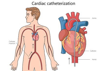 Cardiac catheterization diagram medi, a Healthcare Illustration by AlexArt