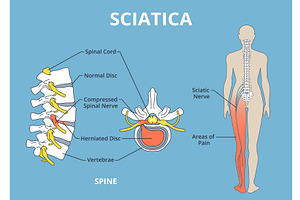 Sciatica pain scheme. Health care, an Object Illustration by YummyBuum