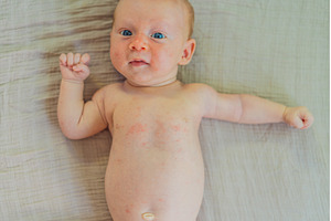 Severe heat rash on newborn baby, a Health & Medical Photo by Elizaveta Galitskaya