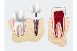 Dental implant structure. Medical, an Object Illustration by the8monkey