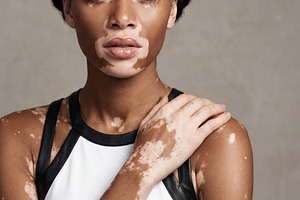 Young Black Woman with Vitiligo, a Beauty & Fashion Photo by Virgo Studio