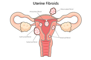 Types of Uterine Fibroids diagram, an Object Illustration by AlexArt