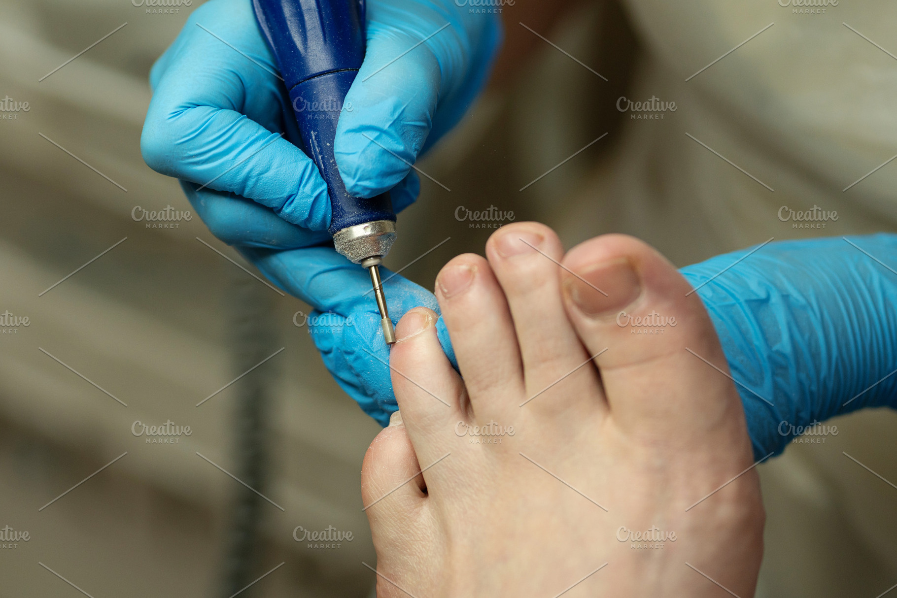 Blue-gloved podiatrist shapes toenai, a Health & Medical Photo by Elena Vagengeim