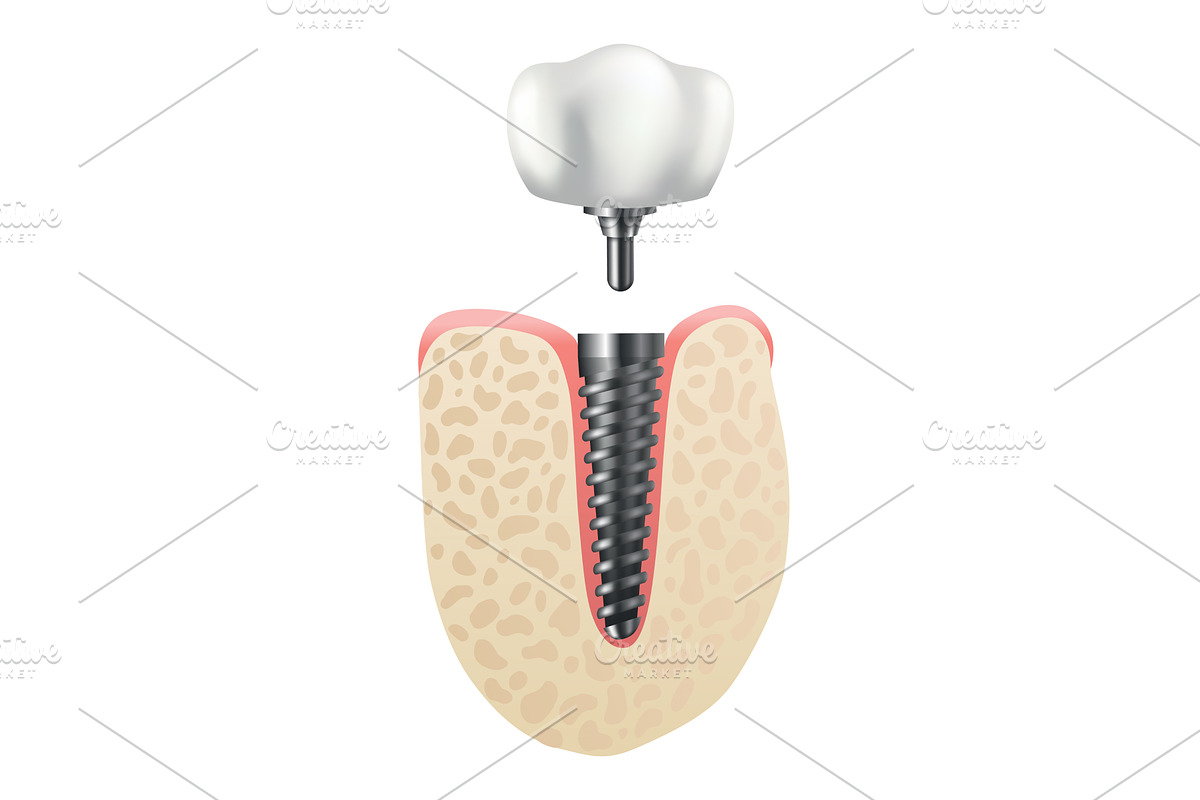 Dental implant structure. Medical, a Healthcare Illustration by the8monkey