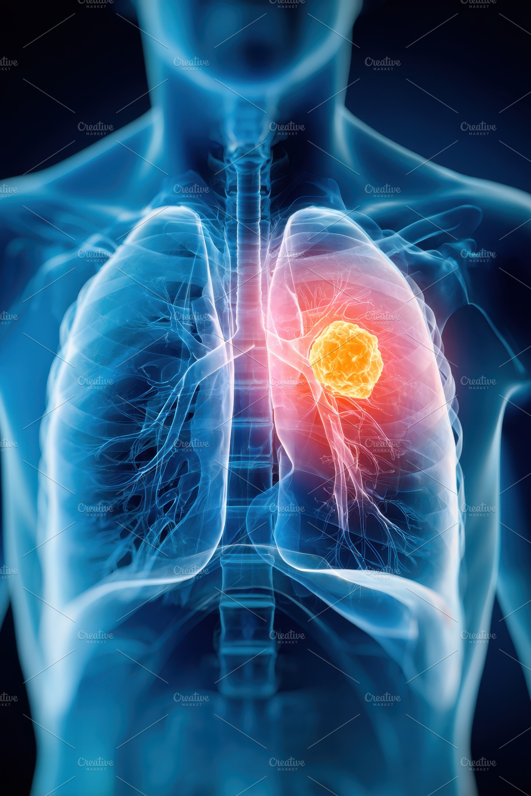 Anatomical illustration of lungs with highlighted tumor, a Health & Medical Photo by AlyaAnd