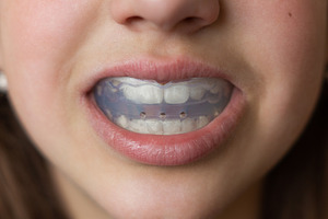 Mouth guard for teeth
