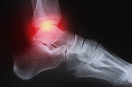 Medical xray knee joint image with featuring arthritis, anatomy, and pain, a Health & Medical Photo by david.herraez.calzad