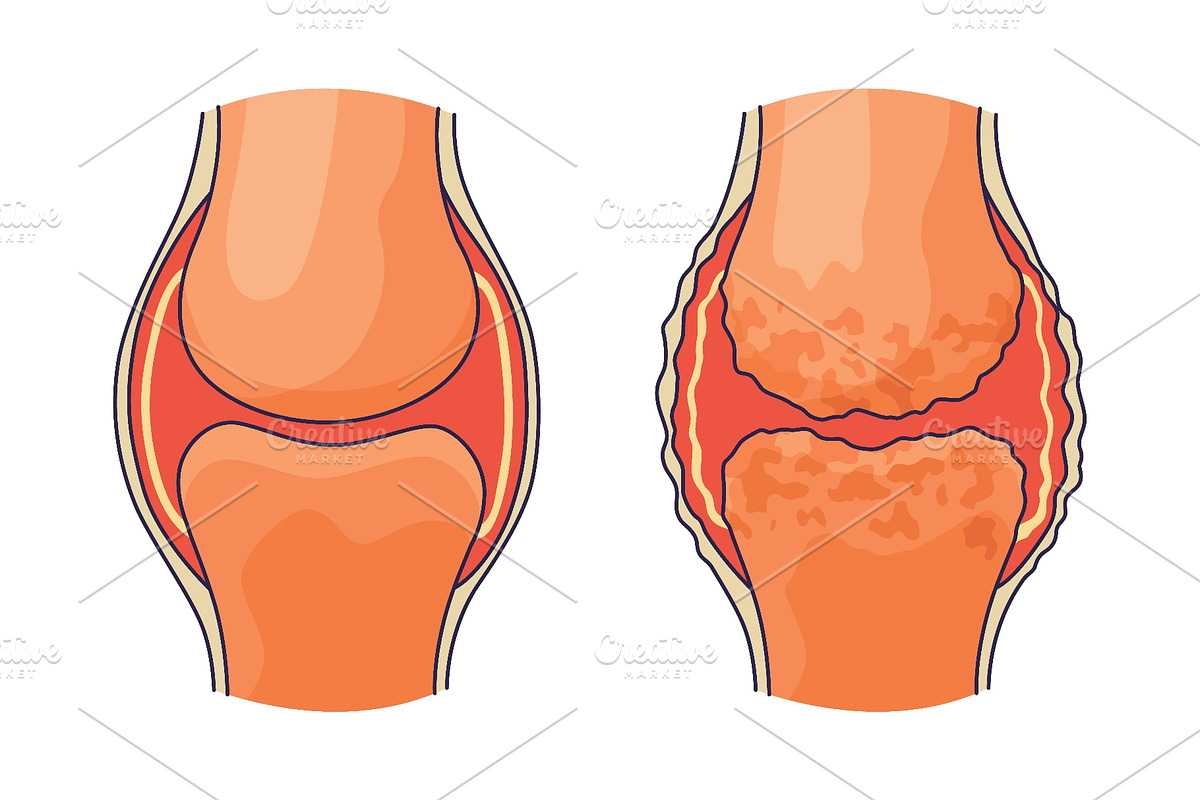 Rheumatoid arthritis. A, an Object Illustration by Things for designers (Photo 1 of 3)