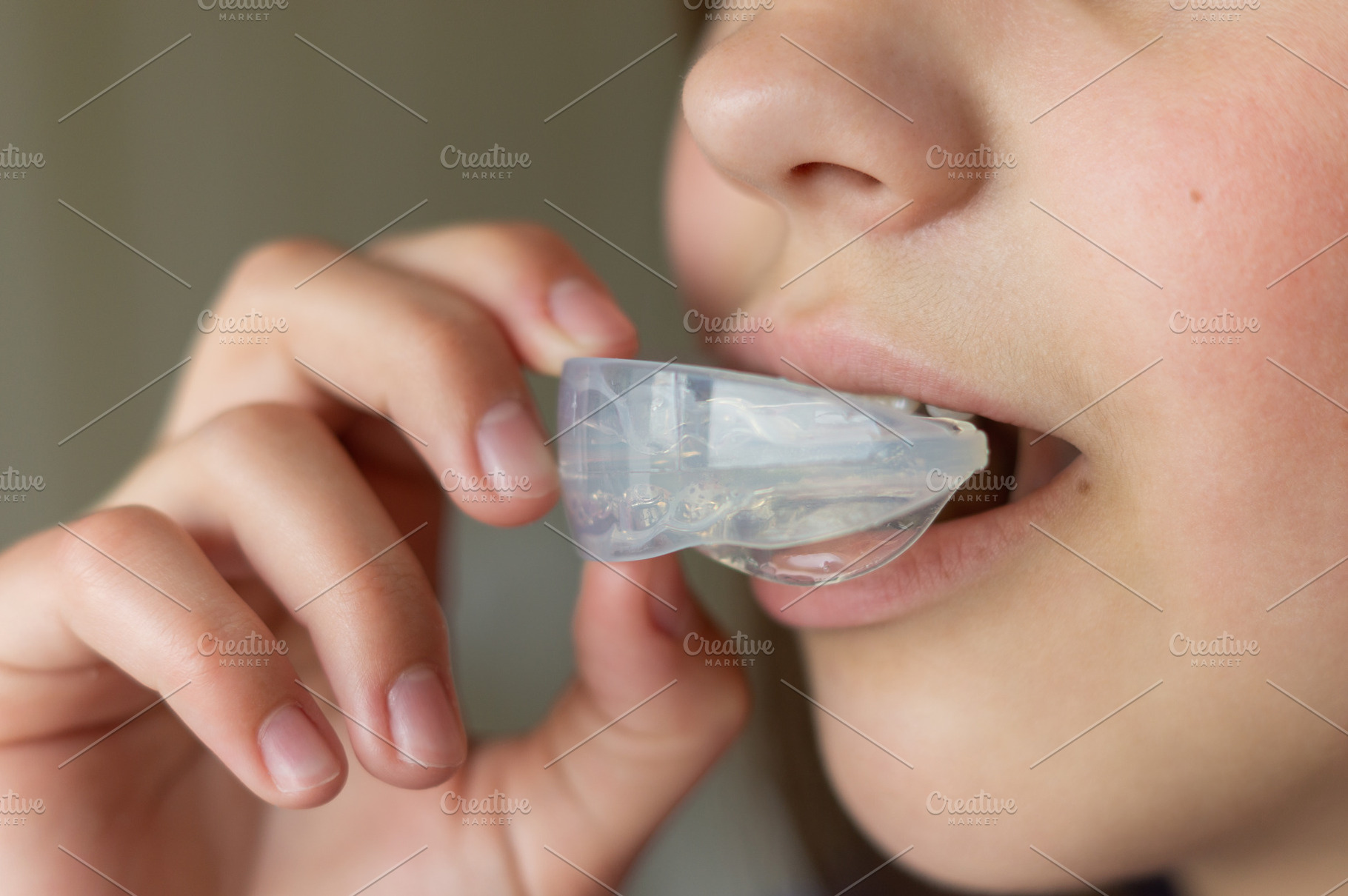 Treatment of crooked teeth, a Health & Medical Photo by Nastya_Velko