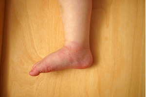 Swollen skin from mosquito bite on a, a Person Photo by darksoul72