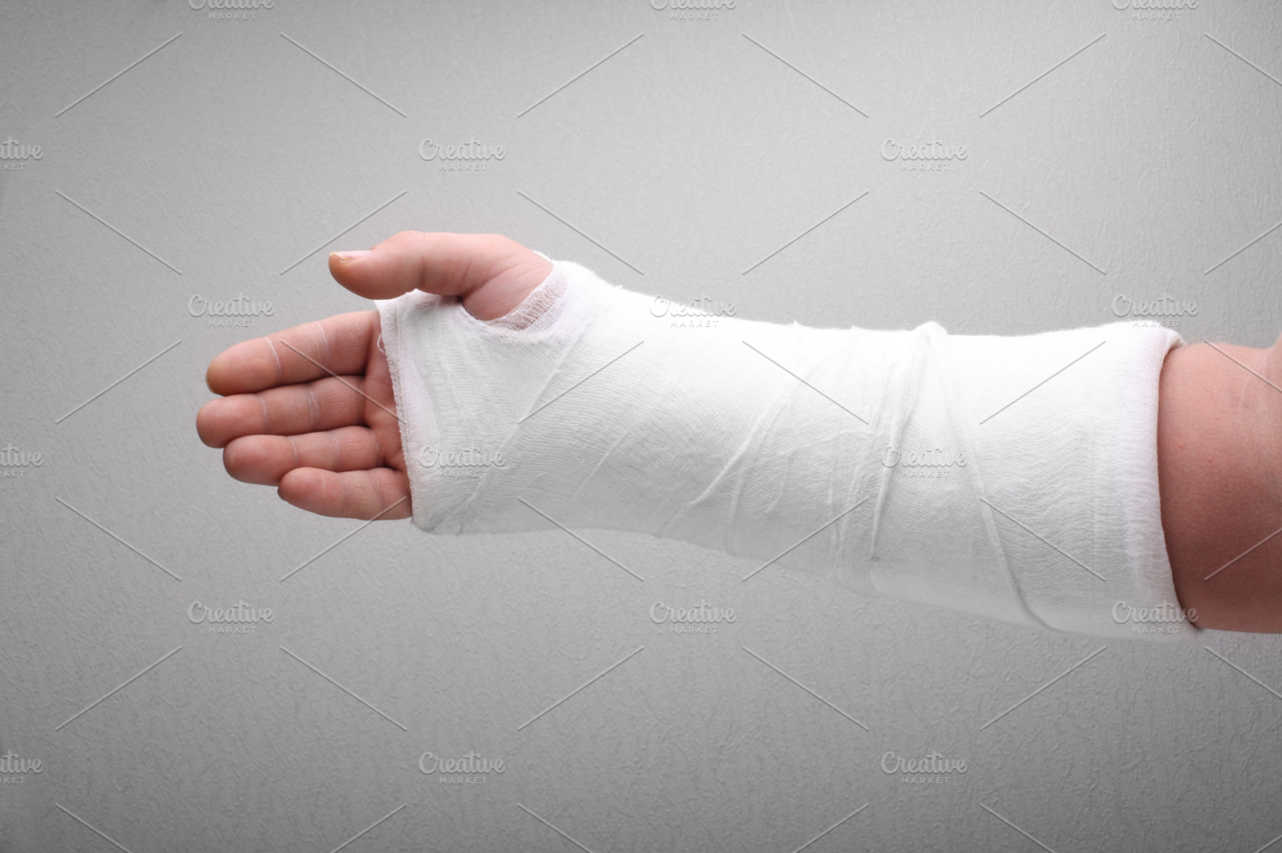 broken arm bone in cast, a Photo by Liliia Rudchenko