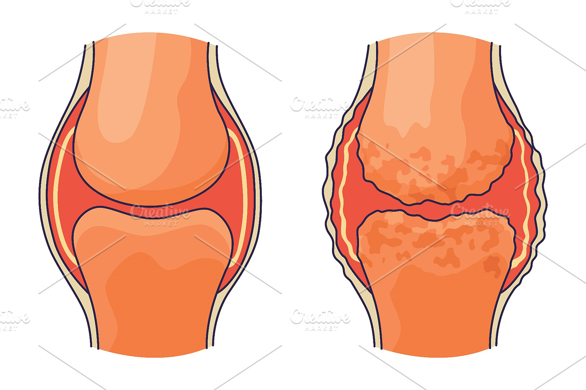 Rheumatoid arthritis. A, an Object Illustration by Things for designers (Photo 2 of 3)