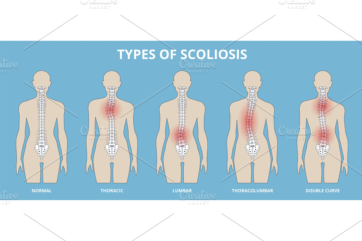 Scoliosis type. Spine curvature, a Healthcare Illustration by YummyBuum