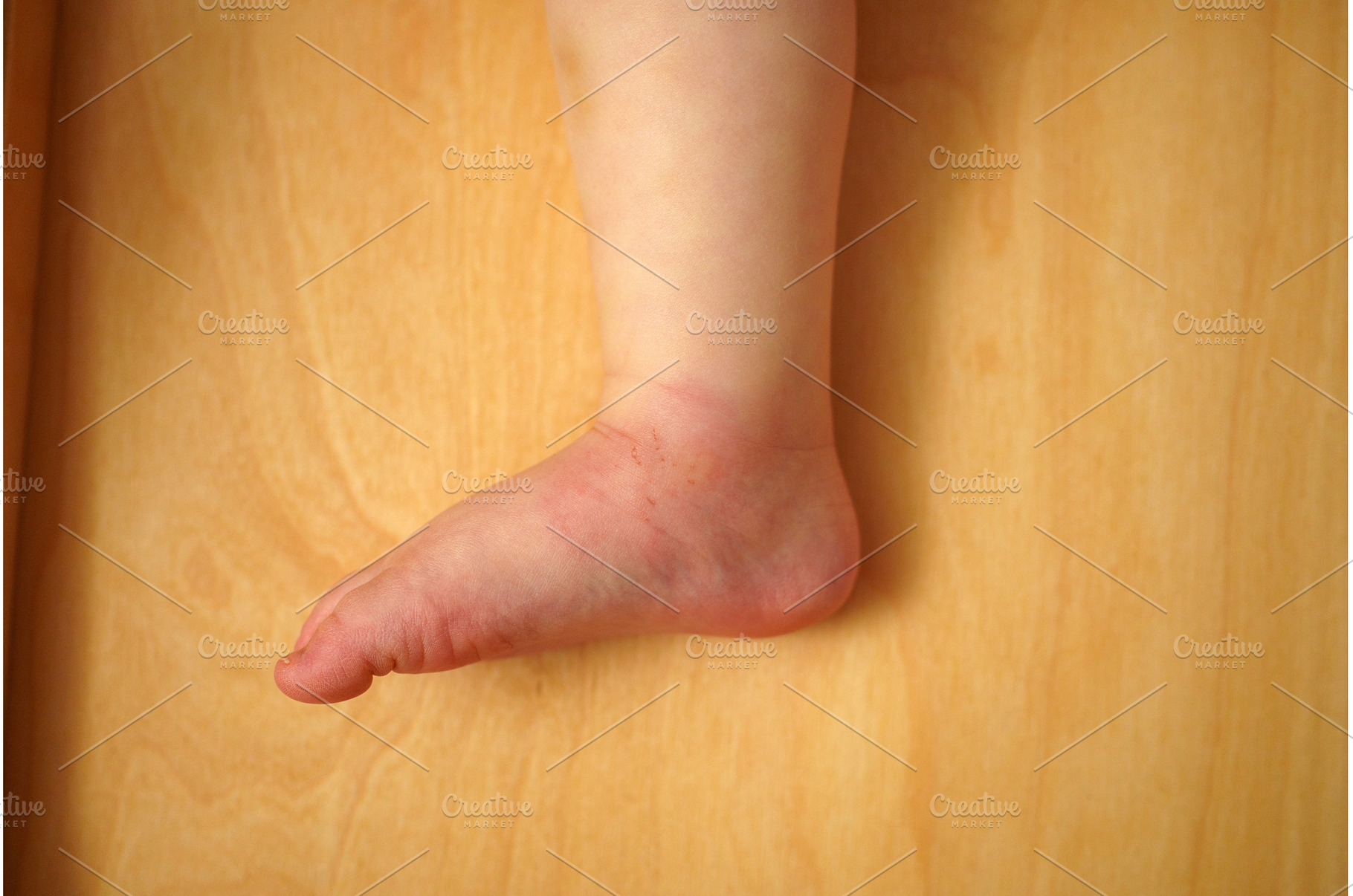 Swollen skin from mosquito bite on a, a Person Photo by darksoul72
