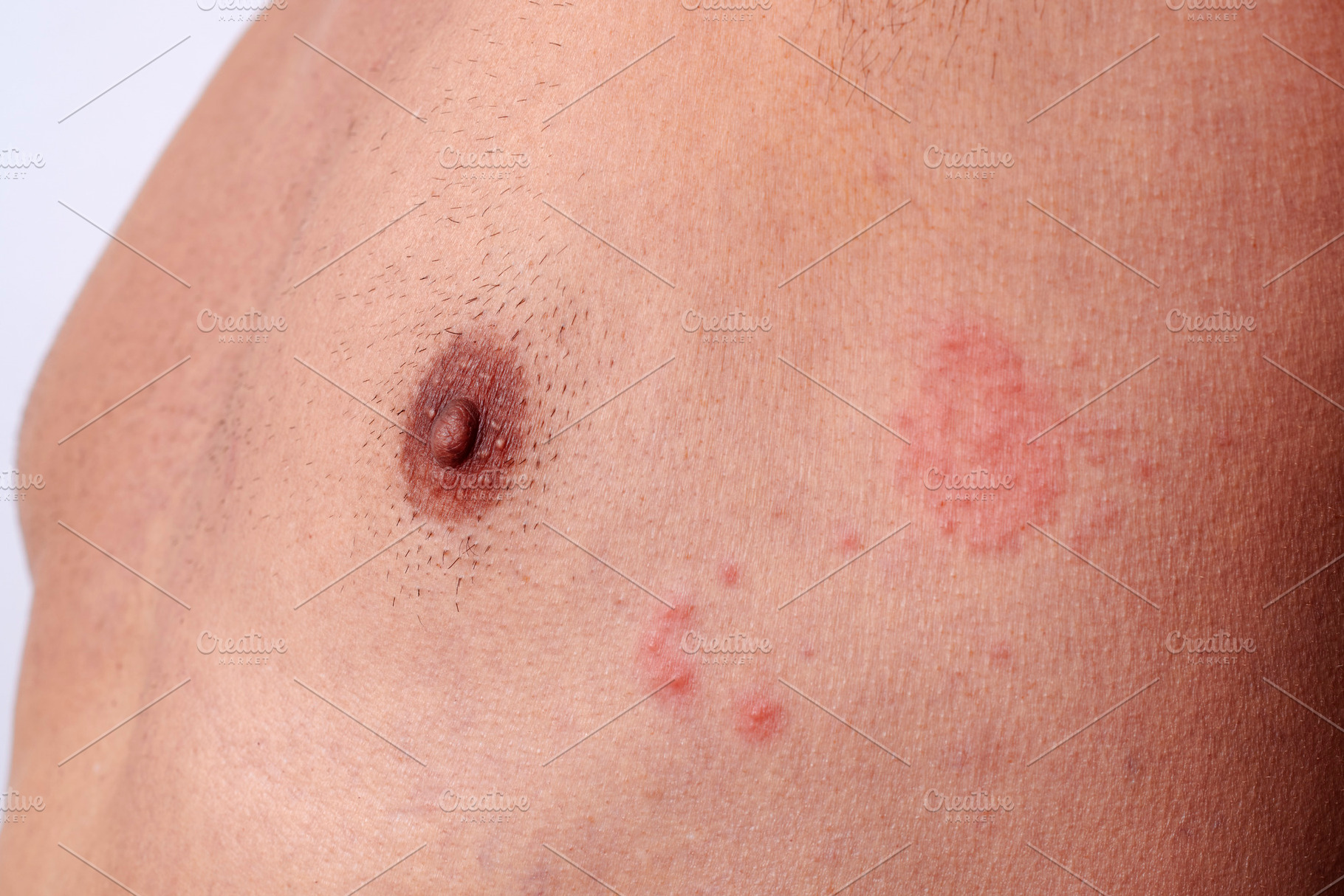 close-up of shingles on the chest of a man, a Photo by Nito