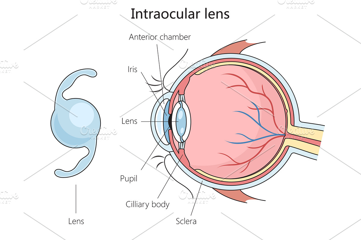 Intraocular lens structure diagram med | Creative Market