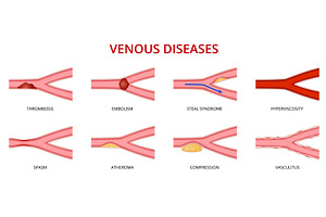 Human vein disease, venous, a Healthcare Illustration by Buch&Bee