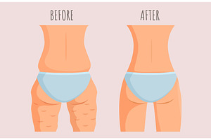 Girl with and without cellulite. Fat, a Healthcare Illustration by Valerie Bodnar