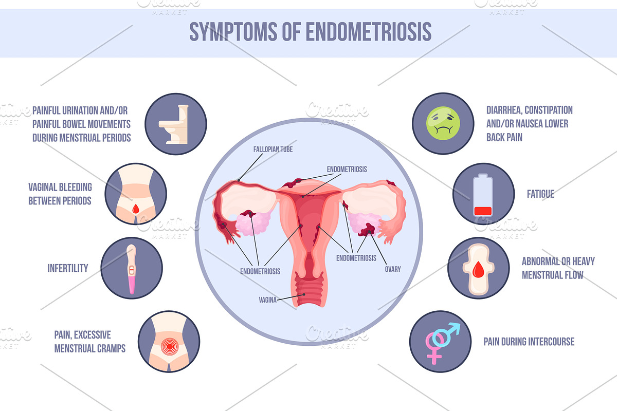 Endometriosis symptom. Uterus, an Object Illustration by Stock-Smart-Start
