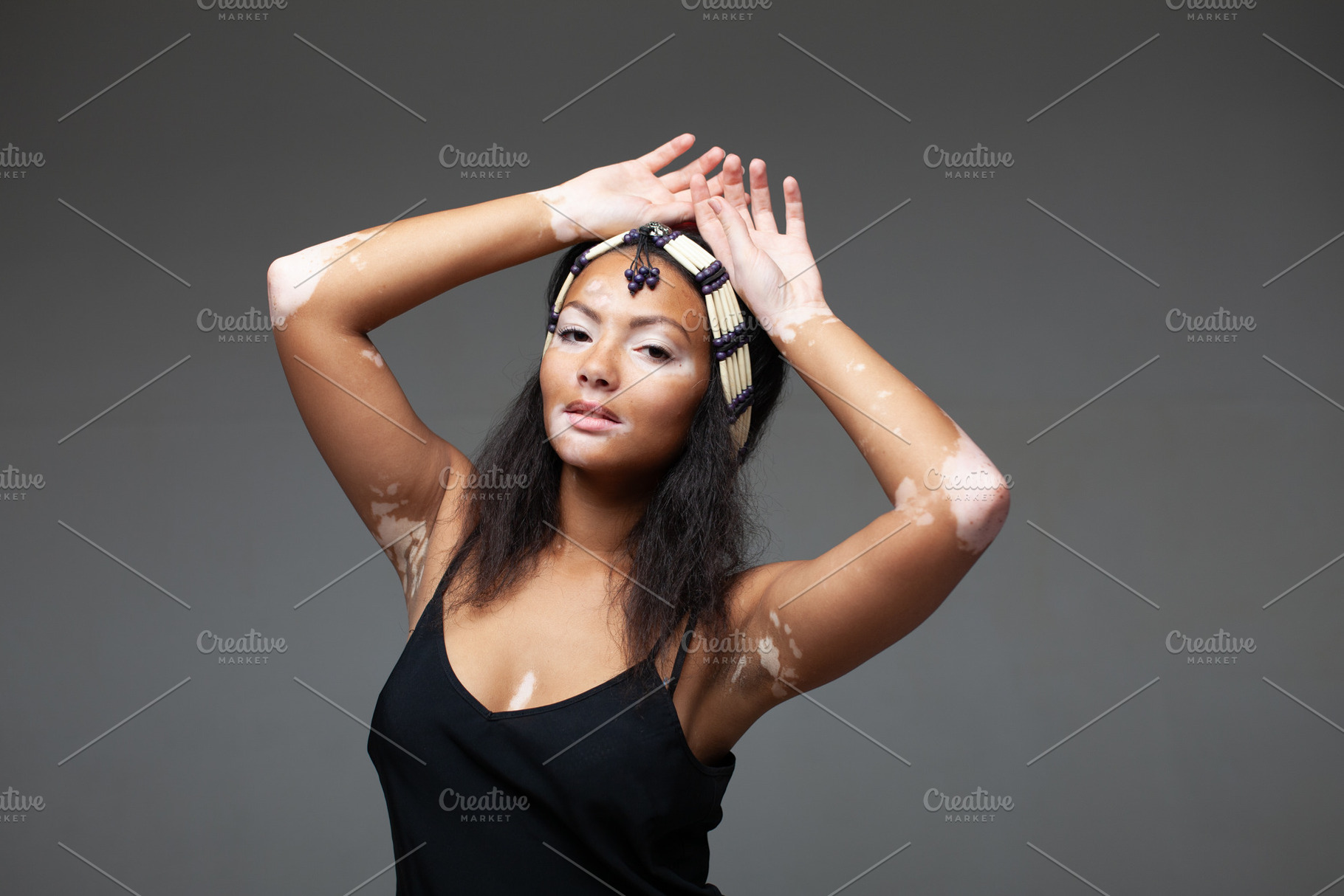 Confident female fashion model with vitiligo posing on gray background, a Photo by andreonegin market