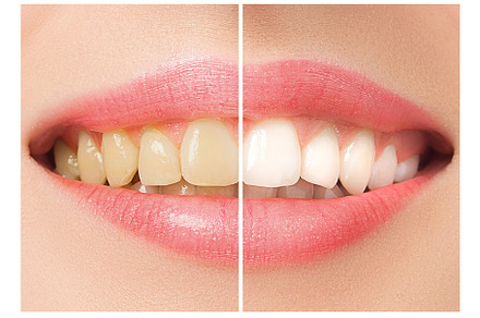 The female teeth before and after whitening featuring whiten, smile, and, a Person Photo by Volodymyr Melnyk