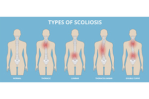 Scoliosis type. Spine curvature, a Healthcare Illustration by YummyBuum